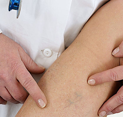 Avaliação clínica de veias superficiais em contexto de tratamento vascular.