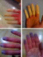 Fênomeno de Raynaud