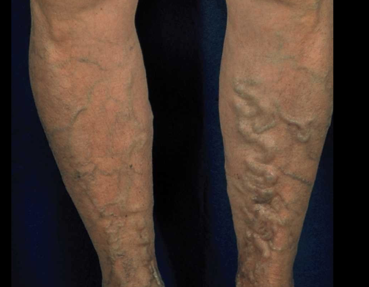 Tratamento de Varizes por Laser - imagem clínica